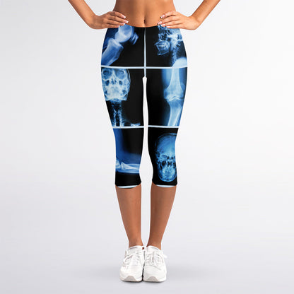 X-Ray Film Radiology Print Women's Capri Leggings